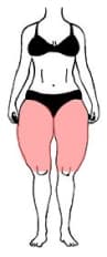 Lipedema di tipo I